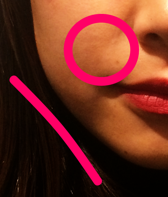 美顔鍼を受けた後の女性の口元。ほうれい線が薄くなっている。